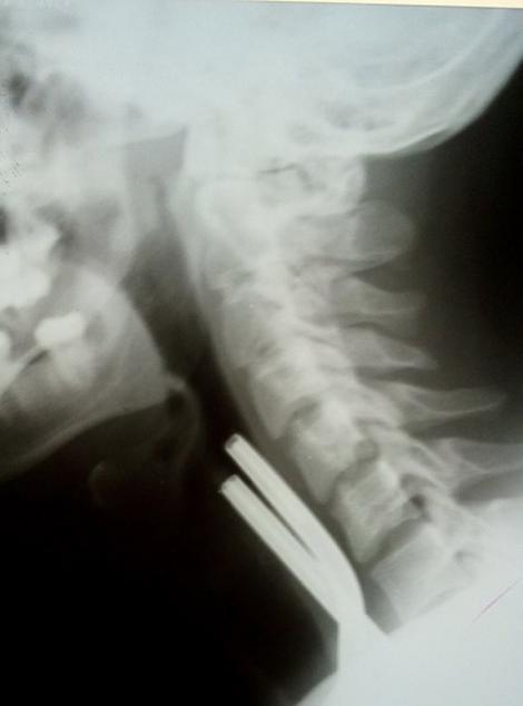 FOTO: Doctorii s-au îngrozit când au văzut ce se află în GÂTUL unui bărbat! L-au operat de urgență! ”În câteva de minute murea”