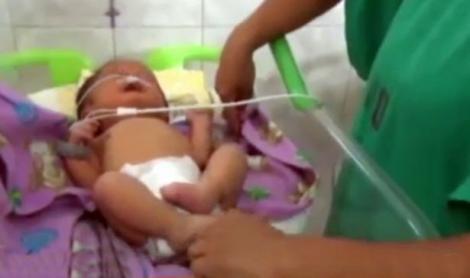 Lumea medicală de pretutindeni a fost în stare de șoc! Un bebeluș s-a născut având două nasuri!
