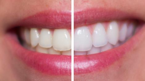 De-acum îți poți albi dinții fără a merge la stomatolog