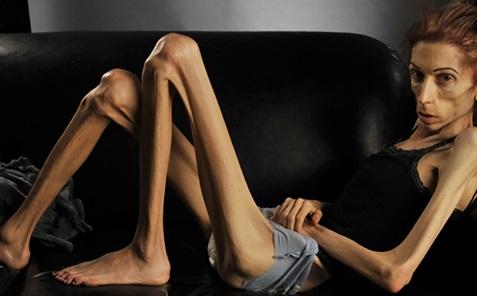 FOTO: C&acirc;ntărea doar 18 kilograme și era la un pas de moarte c&acirc;nd a cerut ajutor! Transformarea spectaculoasă a unei femei de 37 de kilograme