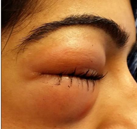 Medicii au rămas fără cuvinte c&acirc;nd au văzut-o! Ce s-a &icirc;nt&acirc;mplat cu o t&acirc;nără după ce şi-a suflat nasul mult prea tare