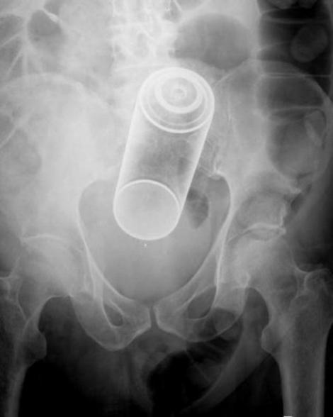 FOTO: Până şi medicii s-au speriat! Cum arată radiografiile pacienţilor cu "PROBLEME" în zonele intime