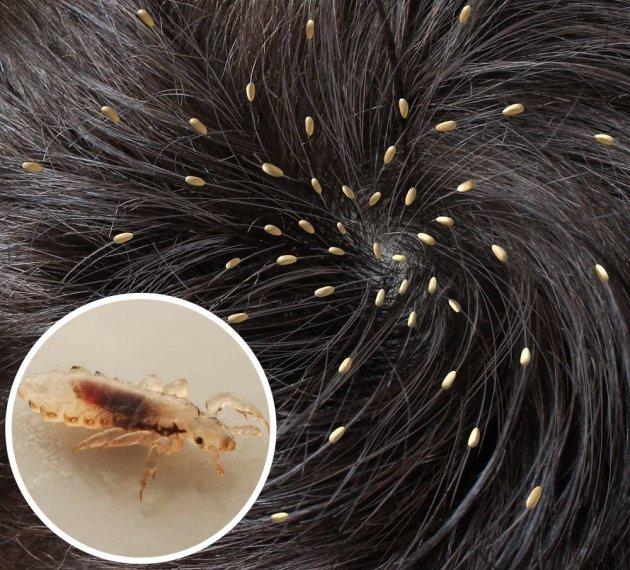 E dezgustător, dar REAL! Unul dintre deserturile tale preferate conține INSECTICID anti-păduchi