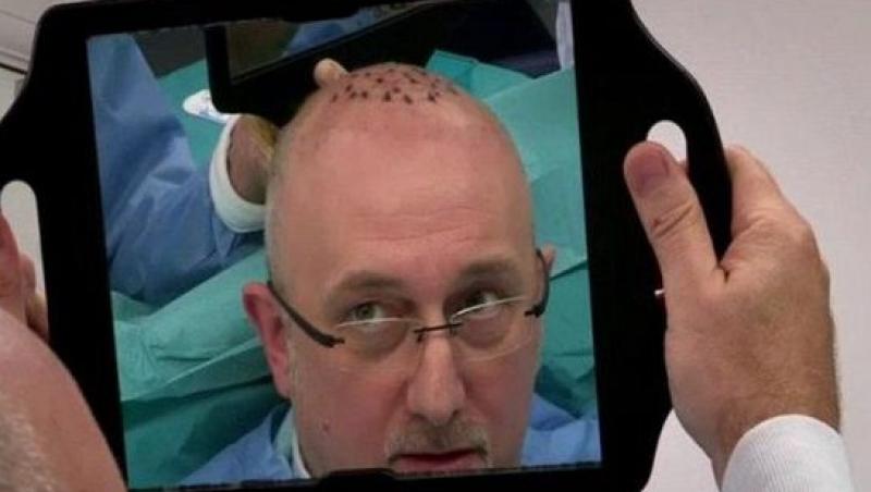 A vrut să fie un bărbat şarmant şi şi-a făcut transplant de păr! Ce a urmat apoi, i-a schimbat radical viaţa! Regretă amarnic!