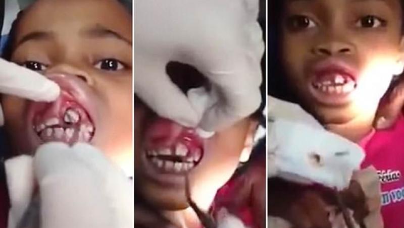 „Se mișcă ceva acolo!” Medicul stomatolog a fost șocat! Uite ce a descoperit în gingia unei fetițe! (VIDEO)
