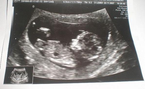 Se &icirc;nt&acirc;mplă odată la 200 de milioane de naşteri! Ce a adus pe lume o t&acirc;nără de 20 de ani. "A fost un adevărat şoc!"