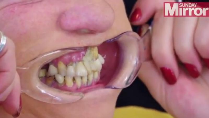 Doamne, ce-o fi fost în mintea ei? I-a fost frică de dentist și a ajuns să-și lipească dinții cu super-glue. Cum arată acum!