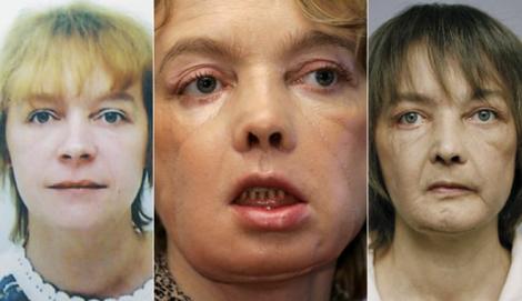 Primul transplant parțial de față din istorie! Povestea femeii care a fost mutilată de propriul câine