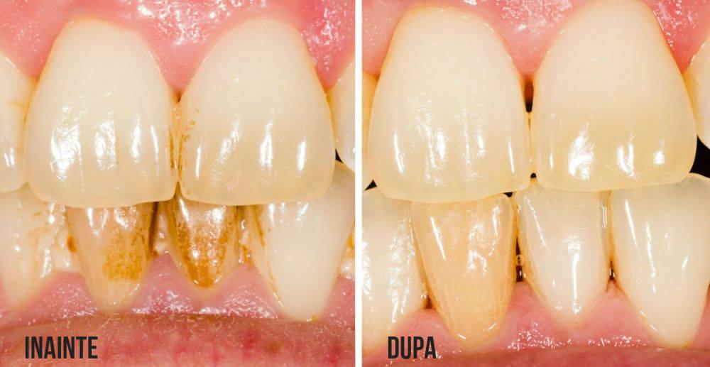 Metoda perfectă de a îndepărta tartrul de pe dinți. Fructele tari, înălbitorii perfecți!