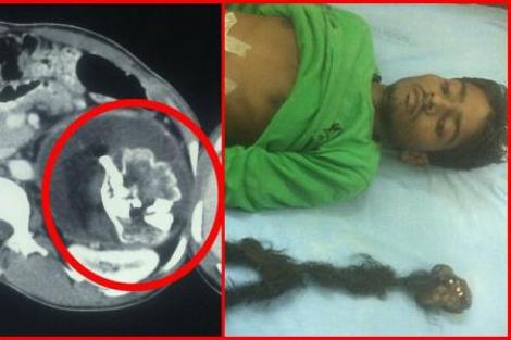 Imagini șocante! Se simțea rău, iar la spital medicii i-au scos din abdomen un fetus de 2,5 kilograme. Explicația specialiștilor îți dă fiori