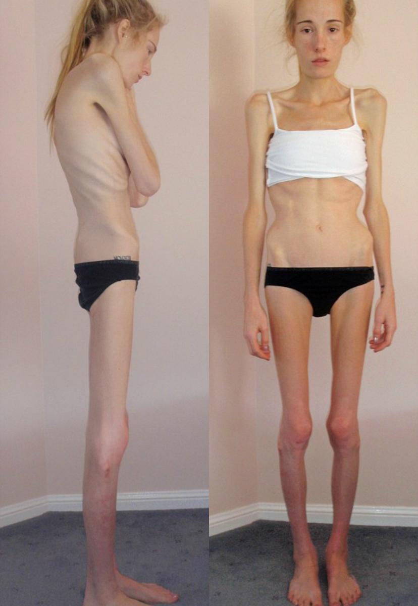 FOTO: C&acirc;ntărea  25 de  kilograme c&acirc;nd medicii i-au spus că mai are de trăit doar 48 de ore! Transformarea spectaculoasă a unei tinere care a văzut moartea cu ochii