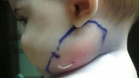 Caz șocant! Medicii au scos o pană din obrazul unei fetițe!