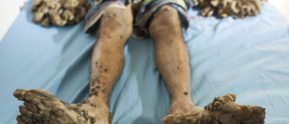 El este bărbatul care se transformă &icirc;n copac! Medicii din &icirc;ntreaga lume sunt șocați