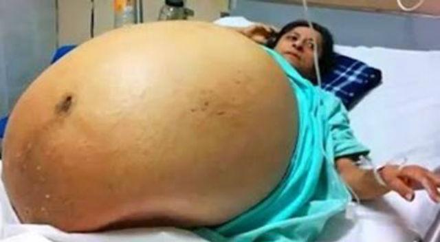 FOTO / Caz unic &icirc;n Australia! A avut o burtă de parcă avea cvadrupleţi, dar medicii au fost şocaţi c&acirc;nd au &icirc;nceput cezariana!