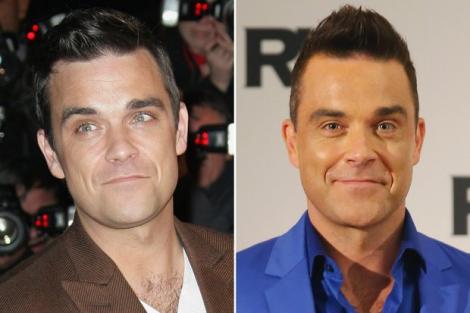 Robbie Williams: „Nu îmi mai pot mișca fruntea din cauza atâtor injecții cu botox!” Cum s-a transformat Făt-Frumos de pe scenă într-o caricatură cu fața inertă