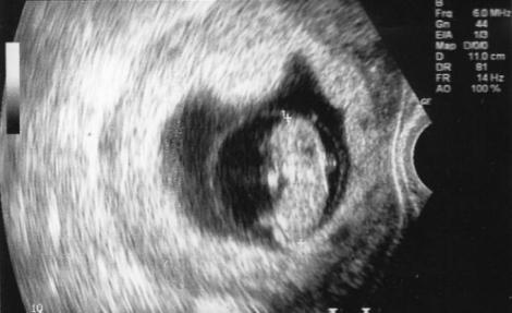 Când au văzut ecografia, medicii au sfătuit-o să renunțe la sarcină. După șapte luni a născut, iar specialiștii au privit îngroziți!
