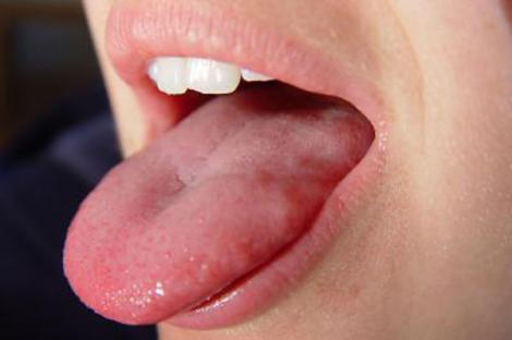Ai limba crăpată? Mergi imediat la medic! Ce boală ai putea să ai