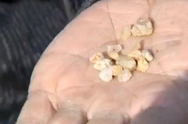 Caz medical extrem de bizar! O femeie pl&acirc;nge cu lacrimi de piatră! De șapte ani, nimeni nu a găsit explicația!