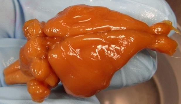 Readus la VIAŢĂ prin criogenarea creierului: &ldquo;Este grozav!&rdquo;