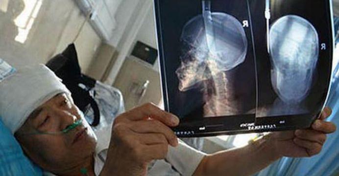 Un chinez a mers cu un cuțit &icirc;nfipt &icirc;n cap, fără să-și dea seama. Ce a pățit după incident