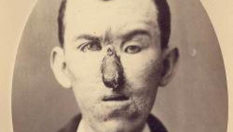 I-a pus un deget în locul nasului! Cum aratău primii soldaţi desfiguraţi pe care un chirurg i-a operat după război. Monştrii cârpiţi. FOTO