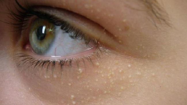 Ce sunt punctele albe și de ce apar pe piele! Trebuie să iei imediat măsuri!