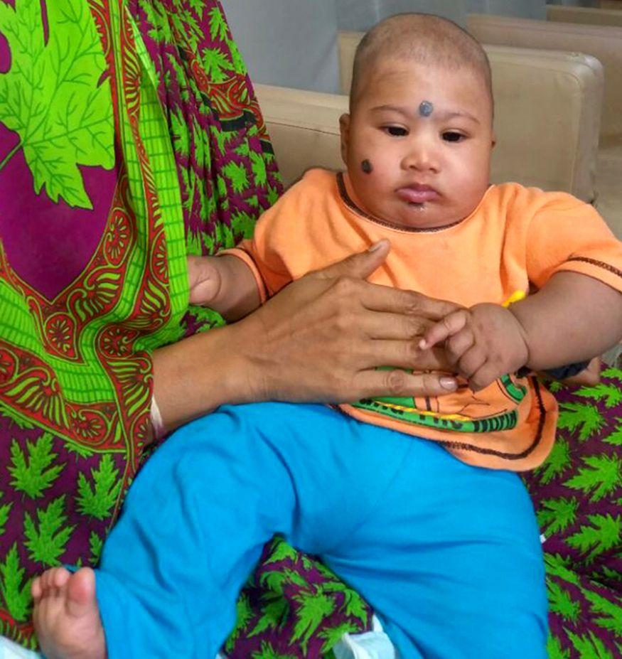 "Bebeluşul cu două capete" a supravieţuit operaţiei! E ŞOCANT cum arată micuţul acum