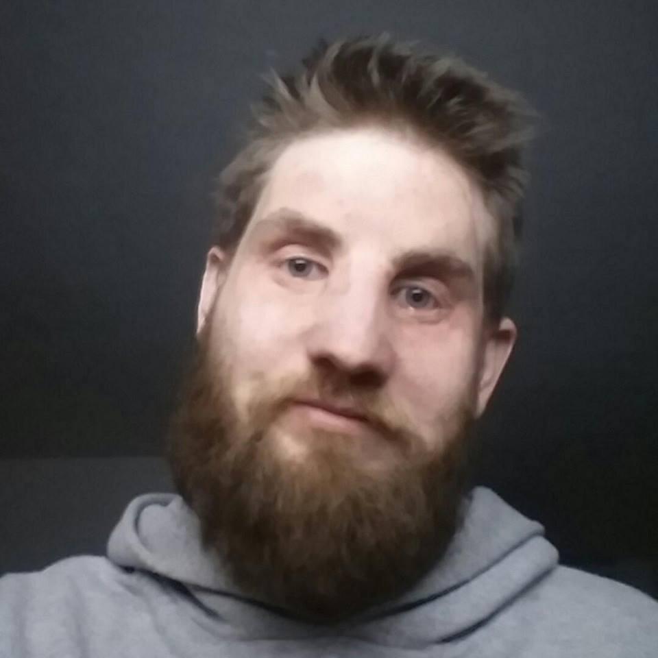 Mii de volți i-au pătruns &icirc;n corp și i-au topit fața! Povestea emoționantă a eroului care a făcut transplant de față!