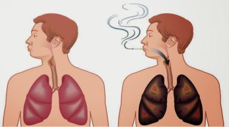 Ai fumat şi vrei să îţi cureţi plămânii? Poţi să o faci ieftin şi natural cu un remediu minune