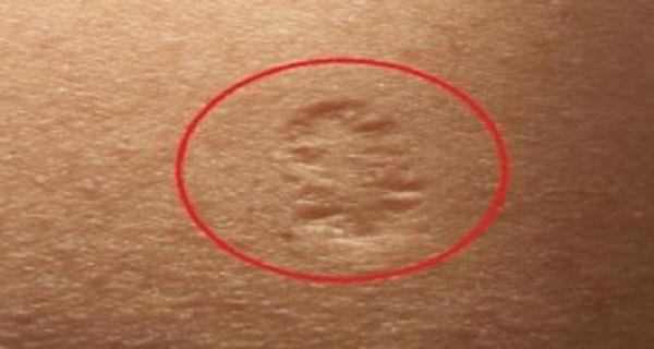 Ai și tu acest semn? Ce reprezintă, de fapt, cicatricea de pe partea superioară a brațului