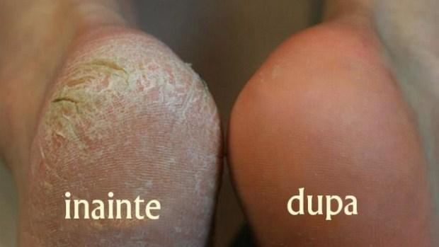 Metoda secretă care te ajută să-ți cureți călc&acirc;iele. Ingredientul ieftin din bucătăria ta