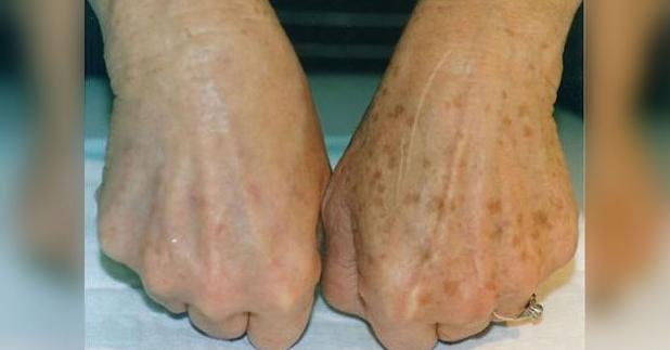 7 boli care pătează pielea. Vezi cum le recunoşti! | Boli şi tratamente, Sănătate | qconf.ro
