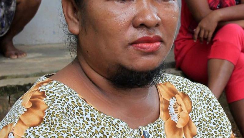 O poveste cutremurătoare despre lupta cu boala și prejudecățile. După 19 ani, o femeie din Indonezia a avut curajul să-și dea jos vălul care-i acoperea fața