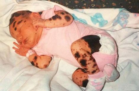 S-a născut cu o boala rară de piele şi i se spunea "fata dalmațian"! Cum arată acum, după 19 ani!