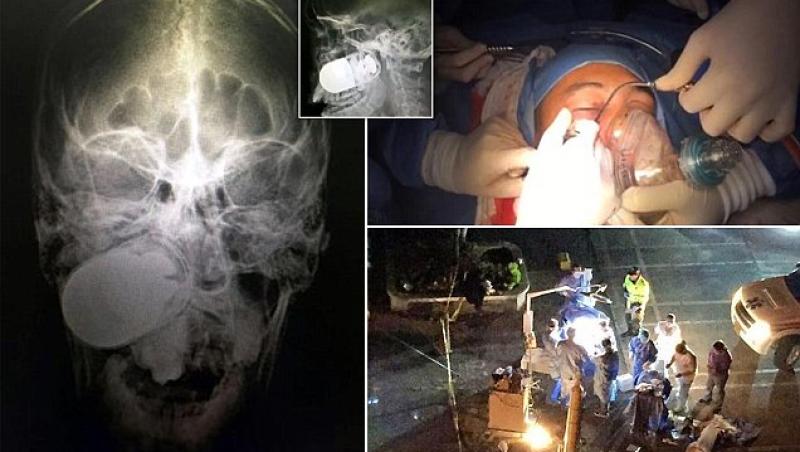 Medicii columbieni în pericol de moarte! Au scos o grenadă amorsată din capul unui soldat: 