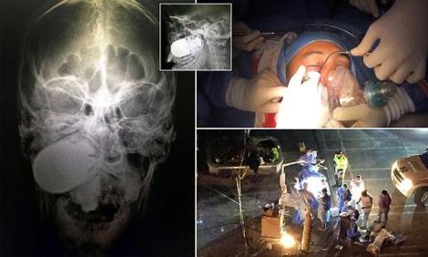 Medicii columbieni în pericol de moarte! Au scos o grenadă amorsată din capul unui soldat: "Nu aveam altă soluție, decât să ne rugăm"