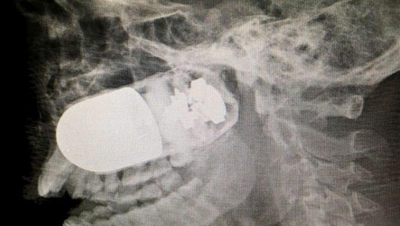 Medicii columbieni în pericol de moarte! Au scos o grenadă amorsată din capul unui soldat: 