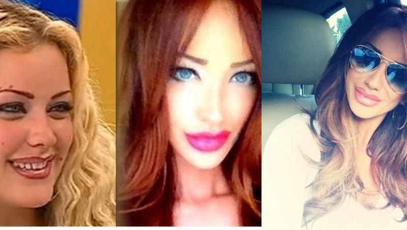 Probleme mari după ce şi-au injectat buzele! Vedete din România dau cărțile pe față: Botoxul desfigurează? 
