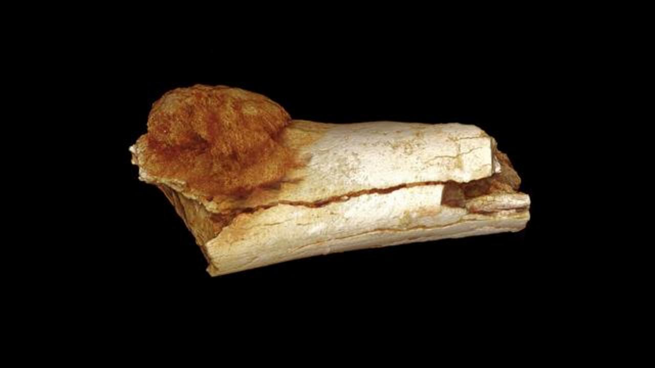 Descoperire uluitoare! Dovada că tumorile canceroase existau și acum 1,7 milioane de ani