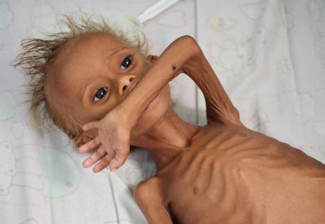 Salut, sunt Salem, băiatul din Yemen. Te-am speriat? Am șase ani și patru kilograme! Da, zici ca-s nou-născut!