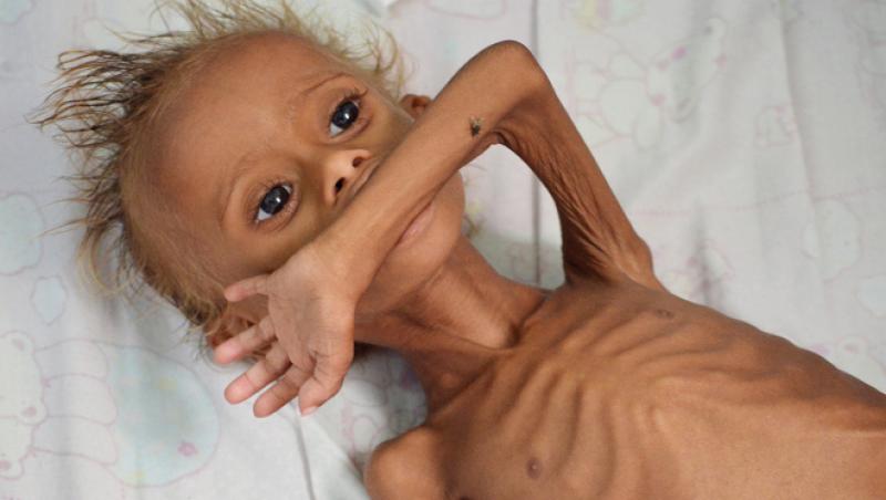 Salut, sunt Salem, băiatul din Yemen. Te-am speriat? Am șase ani și patru kilograme! Da, zici ca-s nou-născut!