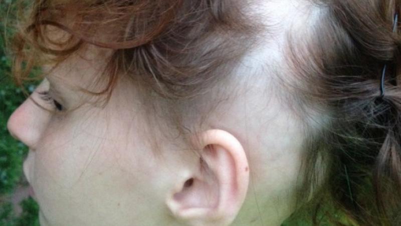 La doar zece ani, un copil a rămas fără păr, sprâncene și gene, din cauza unei greșeli pe care toți părinții o fac: 