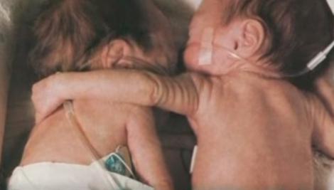 Gemenele îmbrățișate. Cum și-a salvat sora de la moarte la vârsta de trei luni!