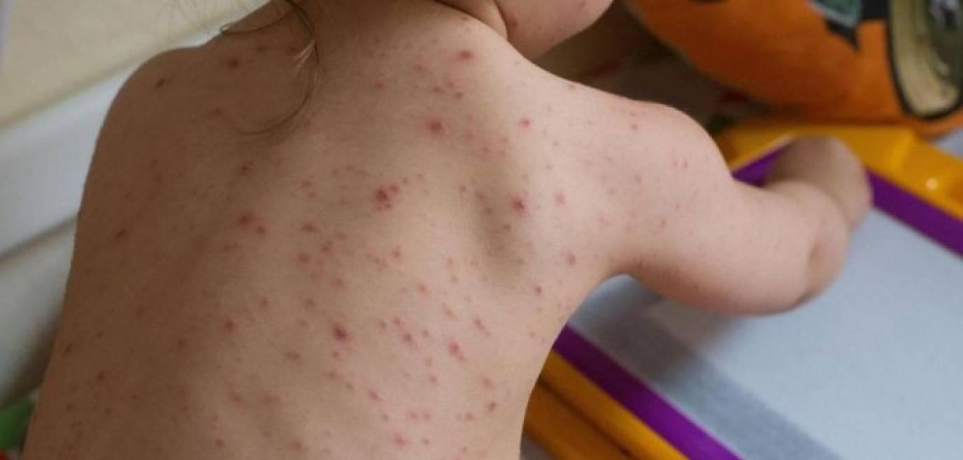 Atenție, părinți! Val de &icirc;mbolnăviri cu rujeolă. Numărul copiilor bolnavi este alarmant