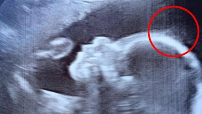 De necrezut. La ecografie părinții au avut un șoc: „Am observat în jurul capului fetiței ceva neobișnuit. După ce am născut-o toată lumea din spital voia să o vadă!”