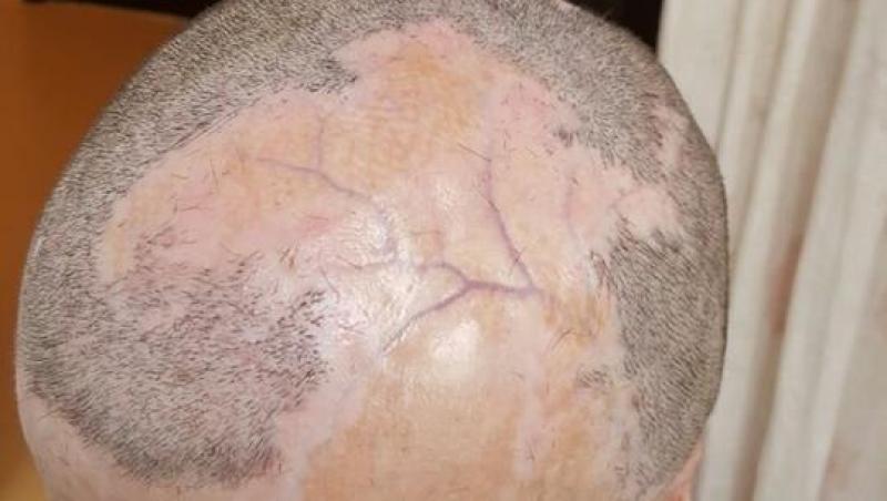 DOI ANI DE LA COLECTIV. Medicul Felix Popescu le-a făcut supraviețuitorilor transplant de păr din banii lui: „Îți dă Dumnezeu cât poți duce. Consider că este o onoare să pot ajuta fără să mi se ofere nimic în schimb!”