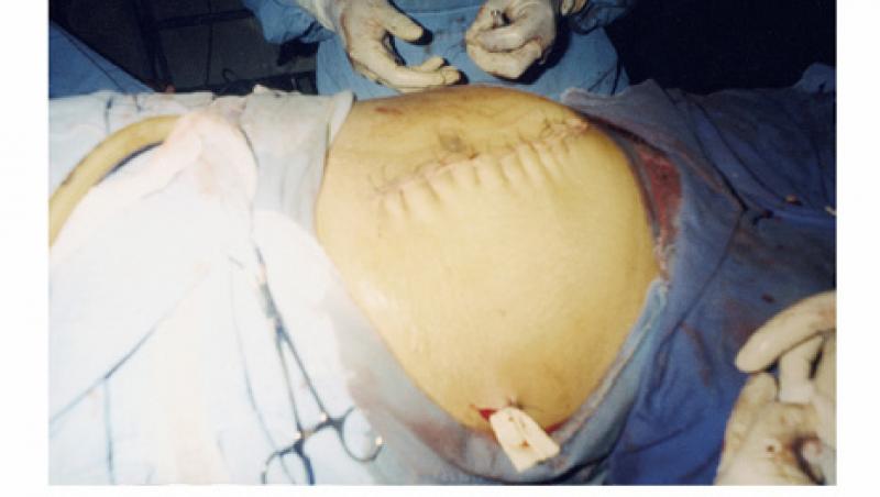 Singura femeie din lume care şi-a făcut operaţie de cezariană singură! După 12 ore de travaliu şi de durere, a luat un cuţit de bucătărie nesterilizat şi și-a făcut pe abdomen o tăietură de 17 cm