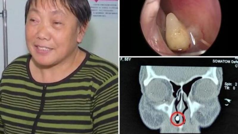 Cazul șocant al unei femei din China! Avea simptome de răceală, dar când a ajuns la spital, medicii au făcut o descoperire bizară şi înfricoşătoare