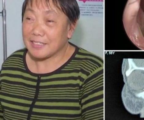 Cazul șocant al unei femei din China! Avea simptome de răceală, dar când a ajuns la spital, medicii au făcut o descoperire bizară şi înfricoşătoare
