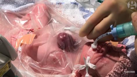 VIDEO! Minune dumnezeiască au numit-o! O fetiță s-a născut cu inima în afara corpului și a supraviețuit